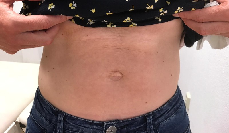 Hoe weet je of je misschien een diastase recti abdominis (DRA) hebt? Foto